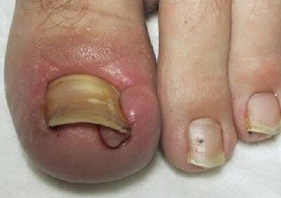 Ingrown toenail non-invasive treatment - The Foot Group