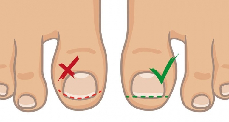 INGROWN NAIL SURGERY Total Care Podiatry