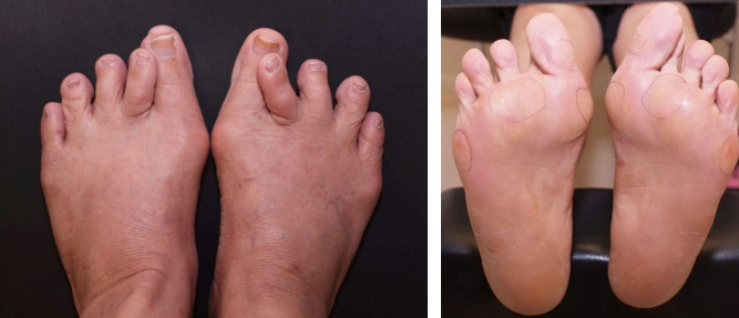 CURLY OR OVERLAPPING TOES??? - Total Care Podiatry