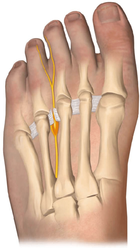 ball-of-foot-sore-you-may-have-morton-s-neuroma-total-care-podiatry