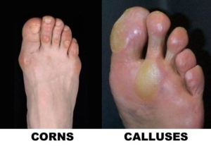 https://totalcarepodiatry.com.au/wp-content/uploads/2020/10/corns-calluses-2-300x207.jpg